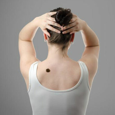 Early Signs of Skin Cancer and How to Diagnose It