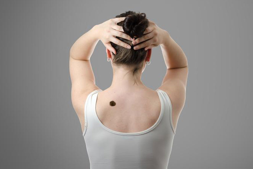 Early Signs of Skin Cancer and How to Diagnose It