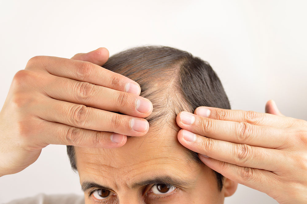 11 Lifestyle Changes to Help Reduce Hair Loss