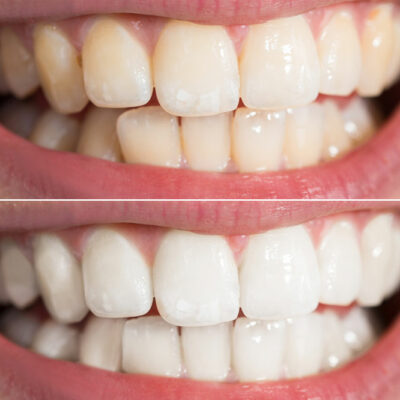 5 Teeth Whitening Methods That Work