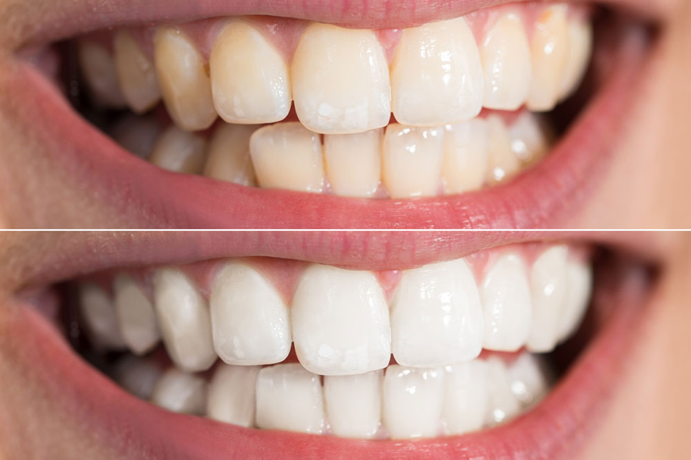 5 Teeth Whitening Methods That Work