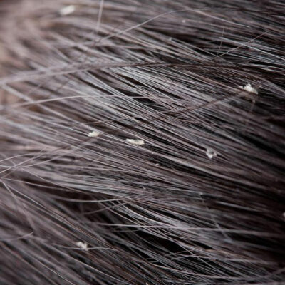7 Hacks to Get Rid of Flaky Scalp and Dandruff