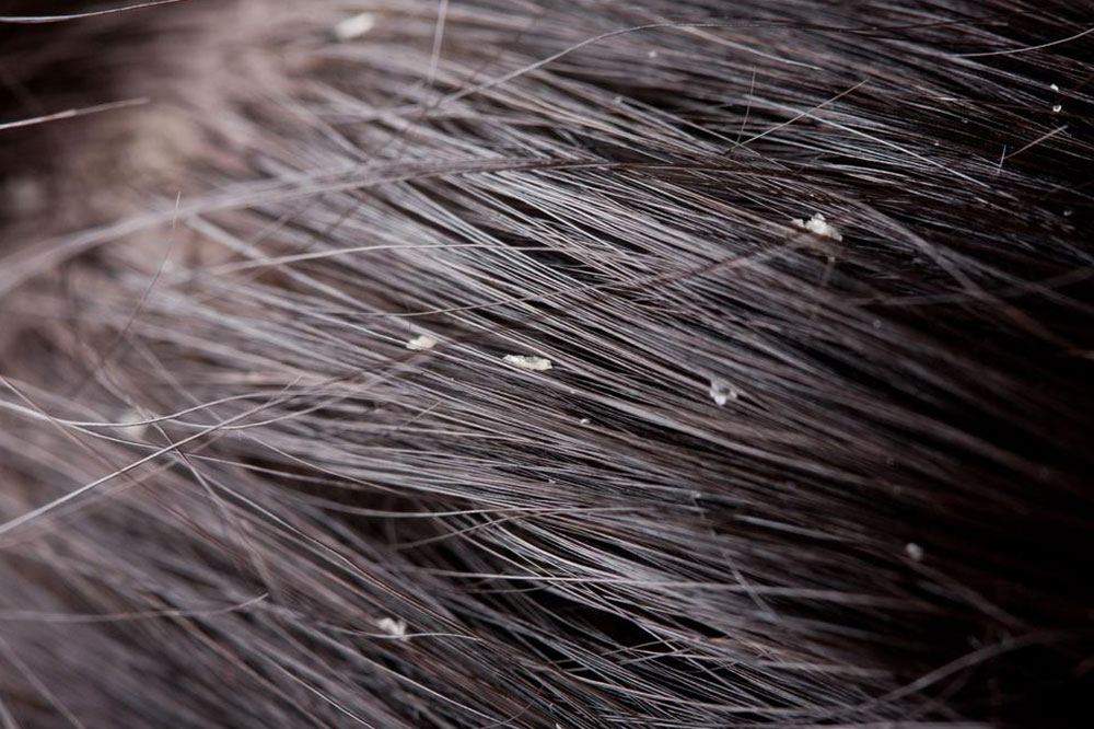 7 Hacks to Get Rid of Flaky Scalp and Dandruff