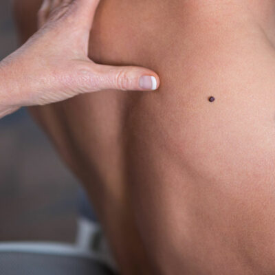 9 Lifestyle Changes to Manage Melanoma