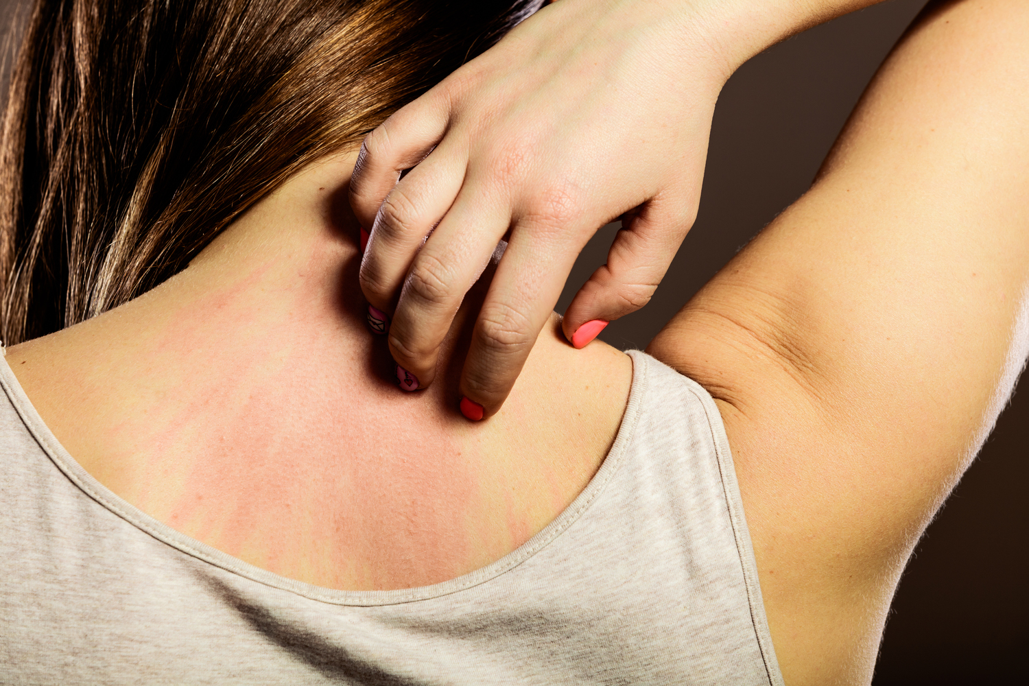 The Worst Cities for Eczema Sufferers